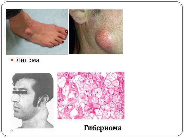  Липома Гибернома 