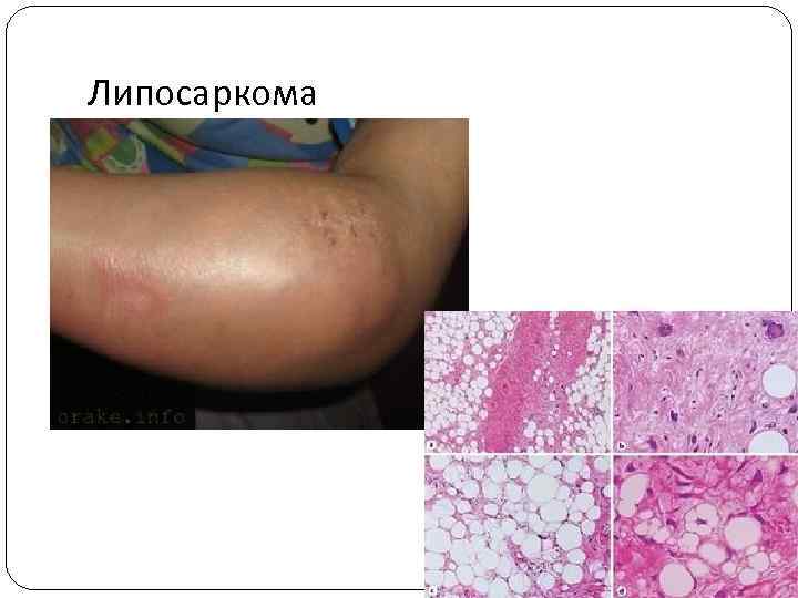 Липосаркома 