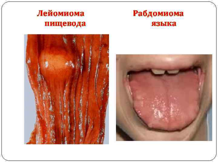 Лейомиома пищевода Рабдомиома языка 