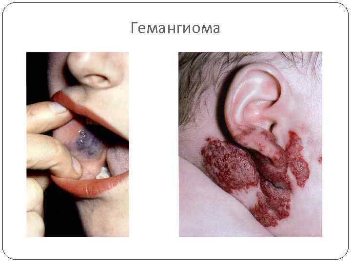 Гемангиома 