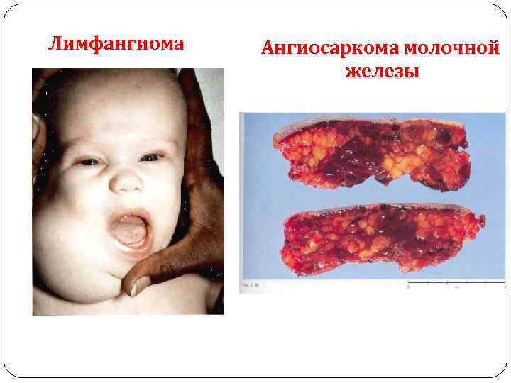 Лимфангиома Ангиосаркома молочной железы 