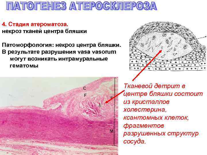 4. Стадия атероматоза. некроз тканей центра бляшки Патоморфология: некроз центра бляшки. В результате разрушения