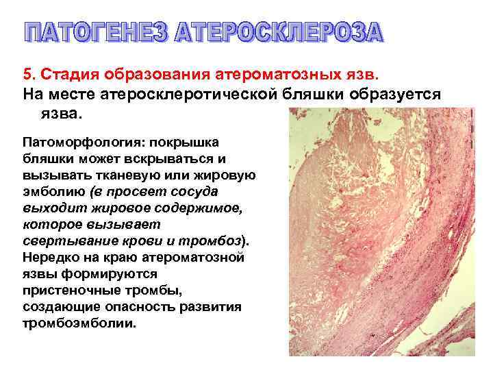 5. Стадия образования атероматозных язв. На месте атеросклеротической бляшки образуется язва. Патоморфология: покрышка бляшки
