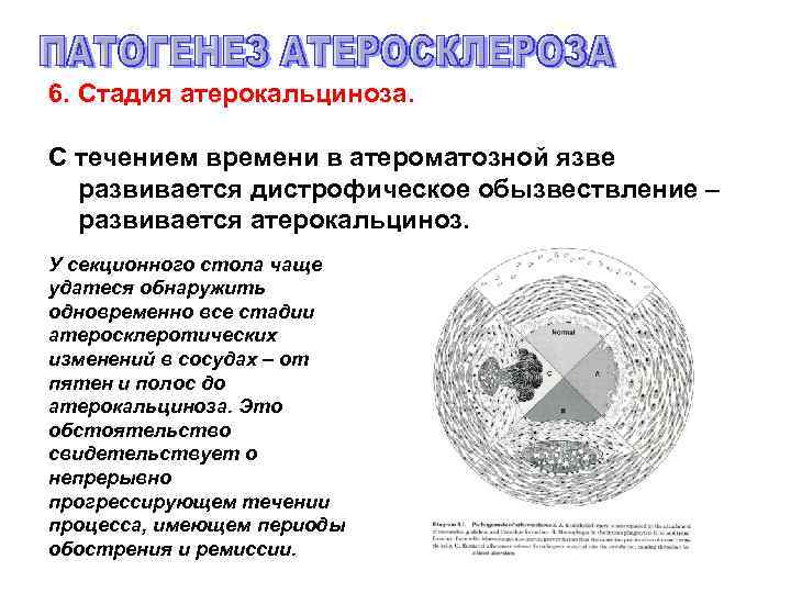6. Стадия атерокальциноза. С течением времени в атероматозной язве развивается дистрофическое обызвествление – развивается