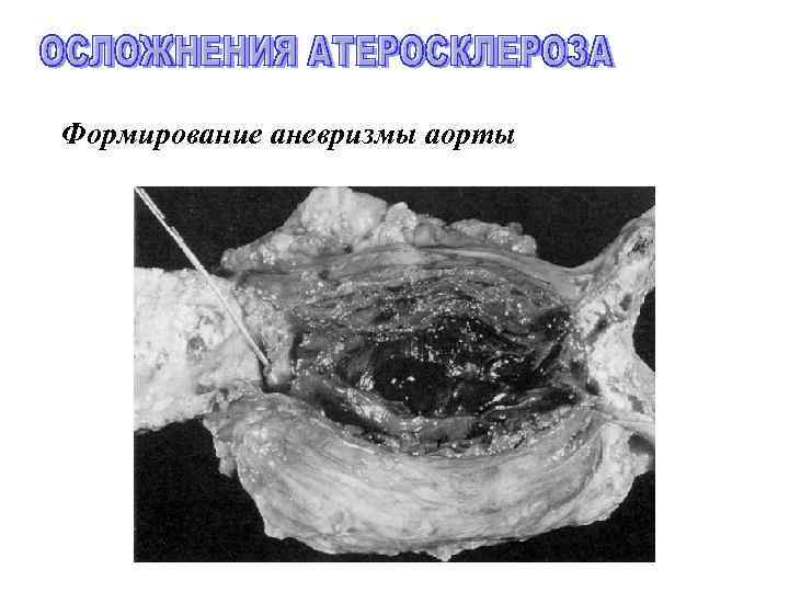 Формирование аневризмы аорты 