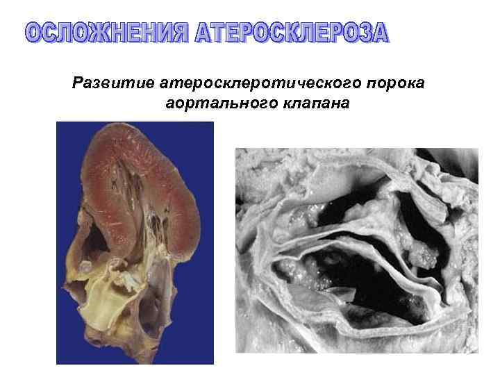 Развитие атеросклеротического порока аортального клапана 