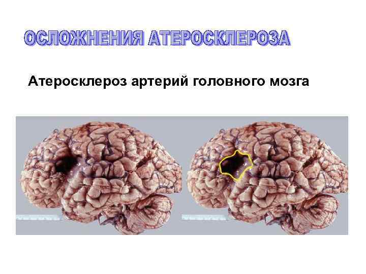 Атеросклероз артерий головного мозга 