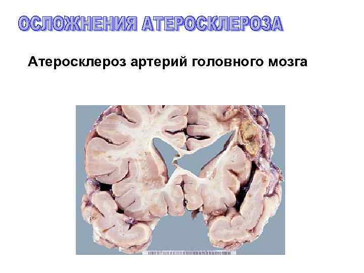 Атеросклероз артерий головного мозга 