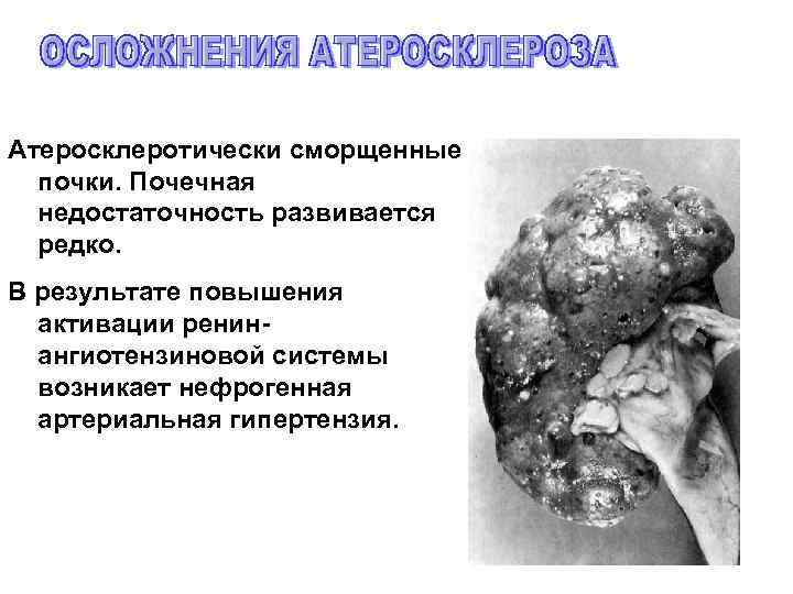 Атеросклеротически сморщенные почки. Почечная недостаточность развивается редко. В результате повышения активации ренинангиотензиновой системы возникает