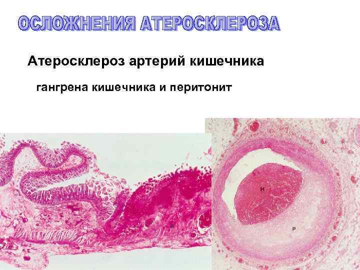 Атеросклероз артерий кишечника гангрена кишечника и перитонит 