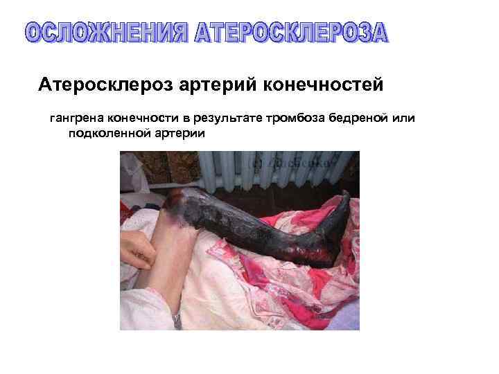 Атеросклероз артерий конечностей гангрена конечности в результате тромбоза бедреной или подколенной артерии 