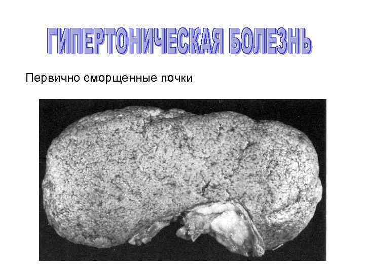 Первично сморщенные почки 