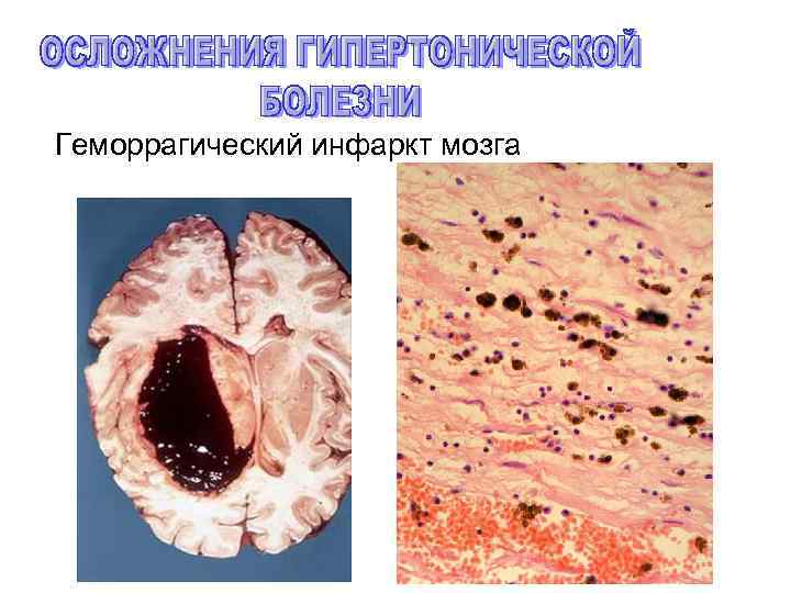 Геморрагический инфаркт мозга 