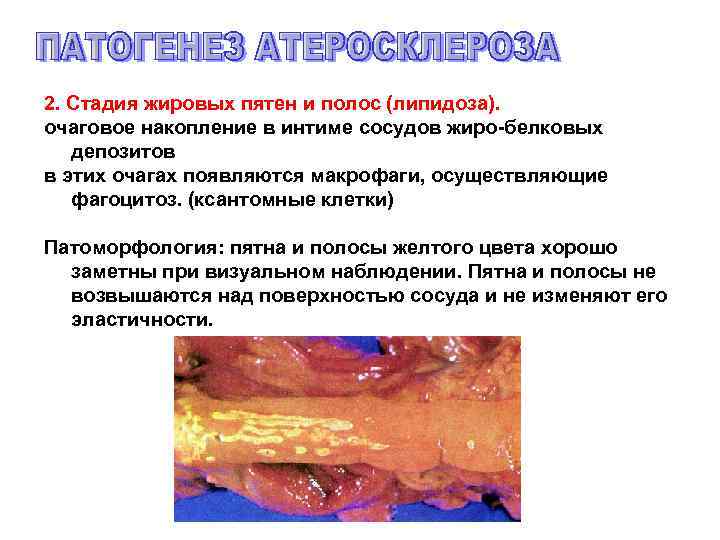 2. Стадия жировых пятен и полос (липидоза). очаговое накопление в интиме сосудов жиро-белковых депозитов