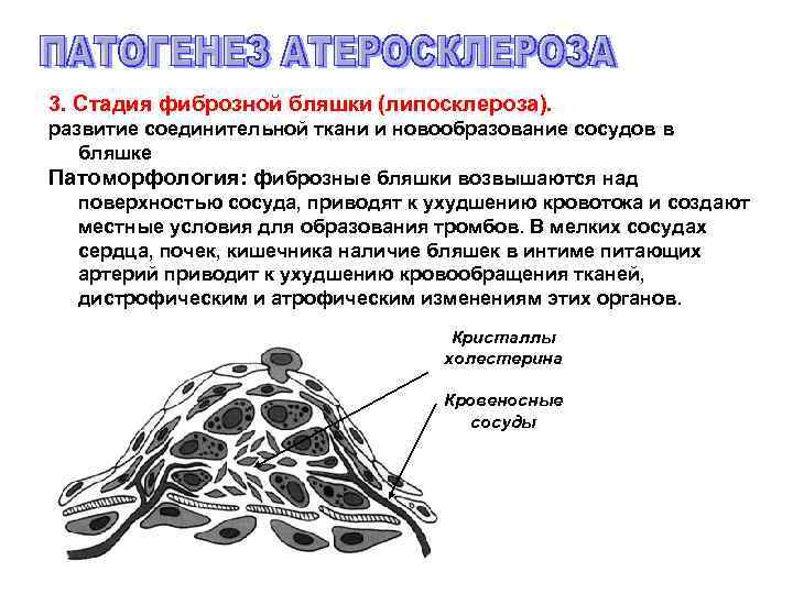 3. Стадия фиброзной бляшки (липосклероза). развитие соединительной ткани и новообразование сосудов в бляшке Патоморфология: