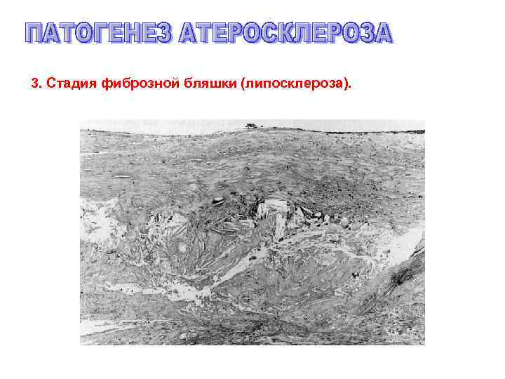 3. Стадия фиброзной бляшки (липосклероза). 