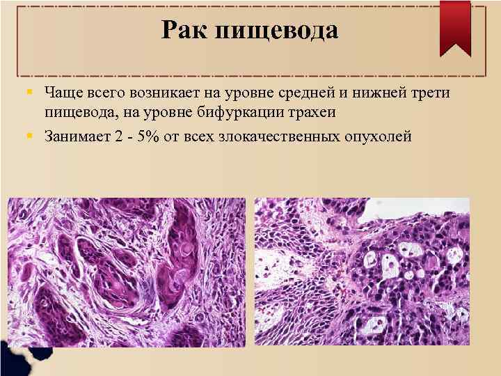 Рак пищевода Чаще всего возникает на уровне средней и нижней трети пищевода, на уровне