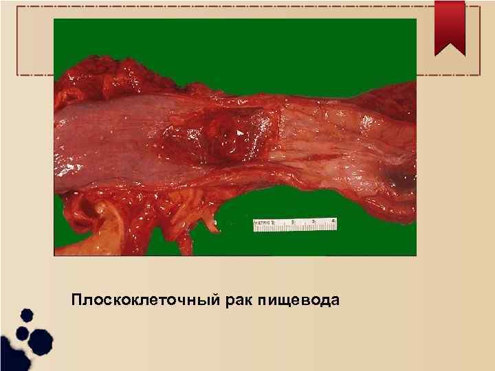 Плоскоклеточный рак пищевода 