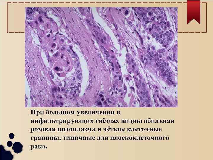 При большом увеличении в инфильтрирующих гнёздах видны обильная розовая цитоплазма и чёткие клеточные границы,