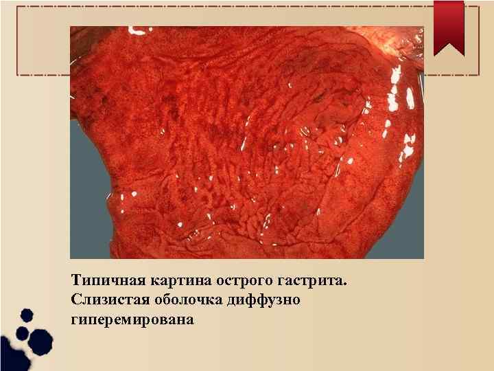 Типичная картина острого гастрита. Слизистая оболочка диффузно гиперемирована 