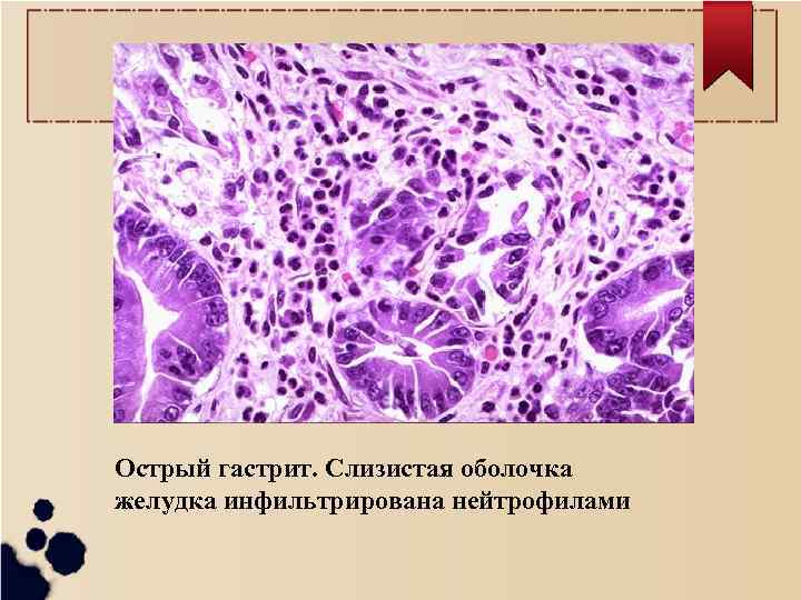 Острый гастрит. Слизистая оболочка желудка инфильтрирована нейтрофилами 