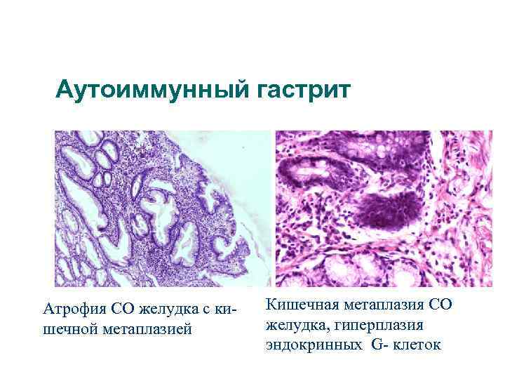 Аутоиммунный гастрит Атрофия СО желудка с кишечной метаплазией Кишечная метаплазия СО желудка, гиперплазия эндокринных