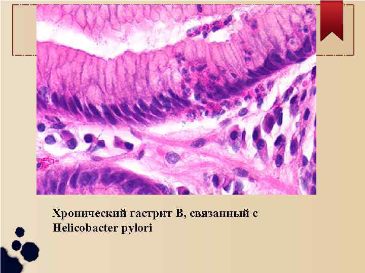 Хронический гастрит В, связанный с Helicobacter pylori 