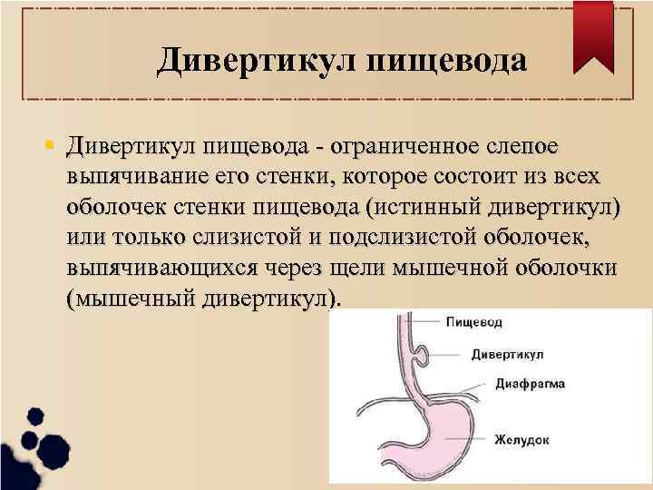 Дивертикул пищевода - ограниченное слепое выпячивание его стенки, которое состоит из всех оболочек стенки