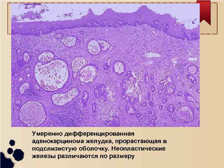 Умеренно дифференцированная аденокарцинома желудка, прорастающая в подслизистую оболочку. Неопластические железы различаются по размеру 