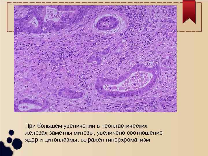 При большем увеличении в неопластических железах заметны митозы, увеличено соотношение ядер и цитоплазмы, выражен
