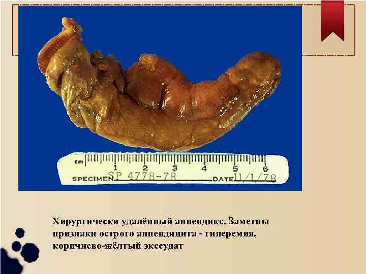 Хирургически удалённый аппендикс. Заметны признаки острого аппендицита - гиперемия, коричнево-жёлтый экссудат 