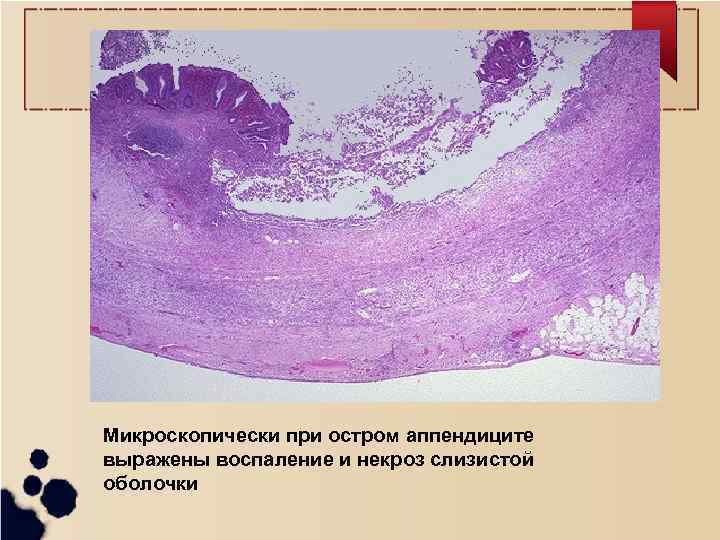 Микроскопически при остром аппендиците выражены воспаление и некроз слизистой оболочки 