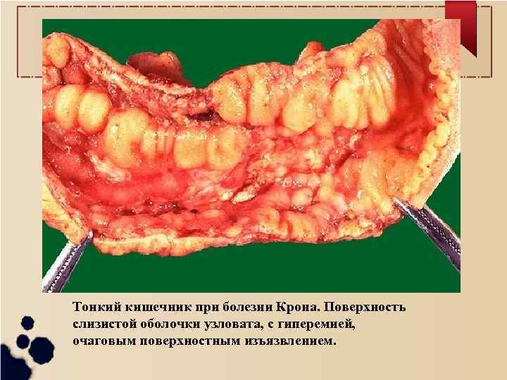 Тонкий кишечник при болезни Крона. Поверхность слизистой оболочки узловата, с гиперемией, очаговым поверхностным изъязвлением.
