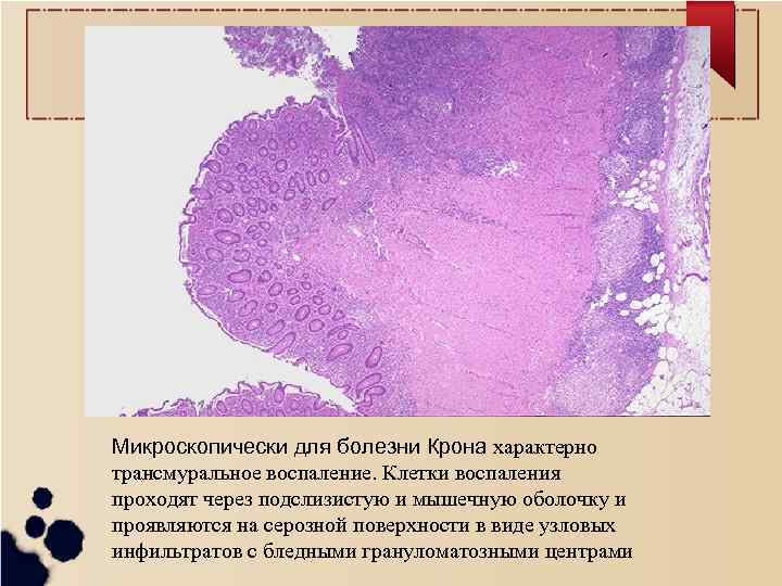Микроскопически для болезни Крона характерно трансмуральное воспаление. Клетки воспаления проходят через подслизистую и мышечную