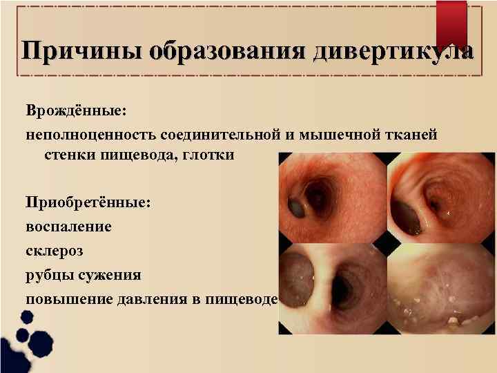 Причины образования дивертикула Врождённые: неполноценность соединительной и мышечной тканей стенки пищевода, глотки Приобретённые: воспаление