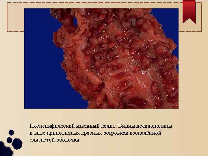 Неспецифический язвенный колит. Видны псевдополипы в виде приподнятых красных островков воспалённой слизистой оболочки 