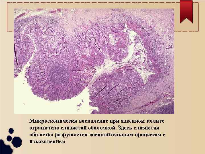 Микроскопически воспаление при язвенном колите ограничено слизистой оболочкой. Здесь слизистая оболочка разрушается воспалительным процессом