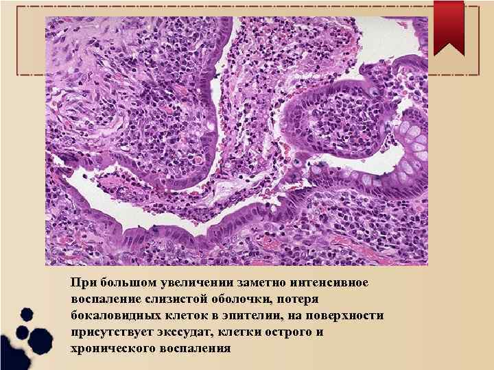 При большом увеличении заметно интенсивное воспаление слизистой оболочки, потеря бокаловидных клеток в эпителии, на