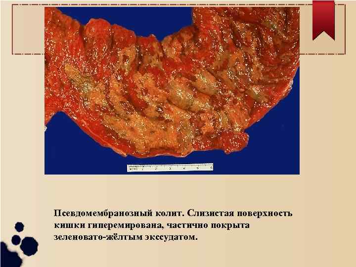 Псевдомембранозный колит. Слизистая поверхность кишки гиперемирована, частично покрыта зеленовато-жёлтым экссудатом. 