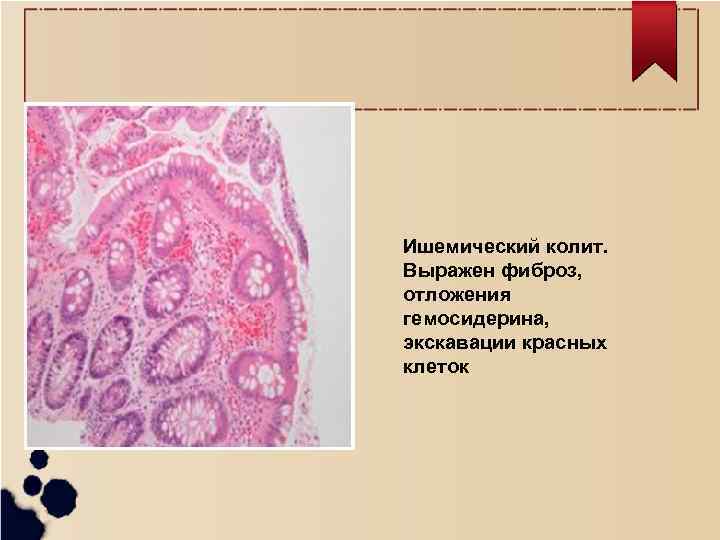 Ишемический колит. Выражен фиброз, отложения гемосидерина, экскавации красных клеток 