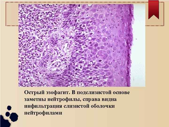 Фиброма пищевода микропрепарат рисунок