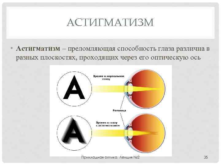 АСТИГМАТИЗМ • Астигматизм – преломляющая способность глаза различна в разных плоскостях, проходящих через его