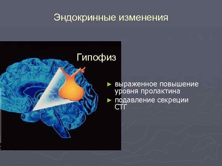 Эндокринные изменения Гипофиз выраженное повышение уровня пролактина ► подавление секреции СТГ ► 