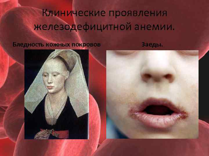 Клинические проявления железодефицитной анемии. Бледность кожных покровов Заеды. 