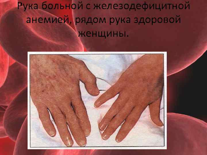 Рука больной с железодефицитной анемией, рядом рука здоровой женщины. 