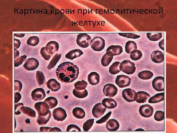 Картина крови при гемолитической желтухе 