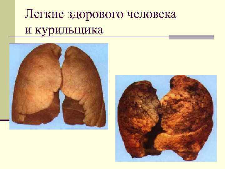 Легкие здорового человека и курильщика 