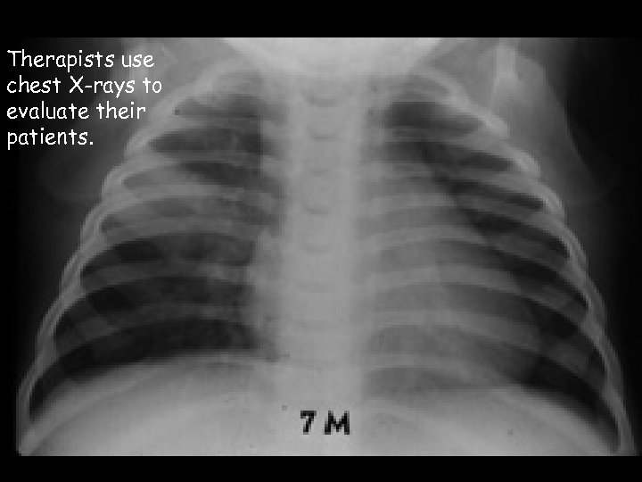 Therapists use chest X-rays to evaluate their patients. 