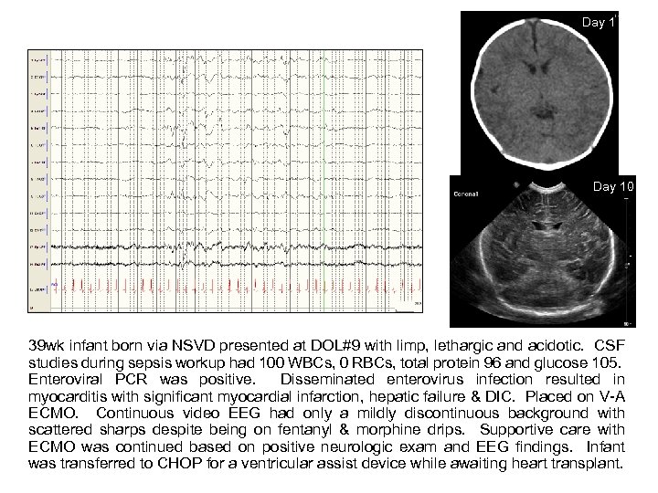 Day 10 39 wk infant born via NSVD presented at DOL#9 with limp, lethargic