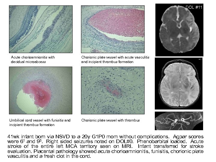 DOL #11 Acute chorioamnionitis with decidual microabcess Umbilical cord vessel with funisitis and incipient